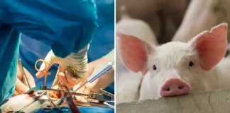 HUMANO RECIBE CON EXITO UN RIÑON DE CERDO
